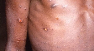 The Greater Accra Region is currently leading the country’s Monkeypox cases by more than 50 percent