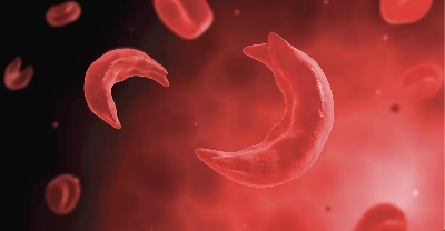 Sickle cell