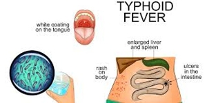 Typhoid fever
