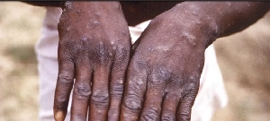 Mpox